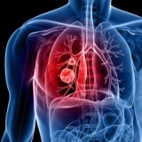 Хроническая обструктивная болезнь лёгких (ХОБЛ / ХОЗЛ)