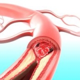 Ишемическая болезнь сердца