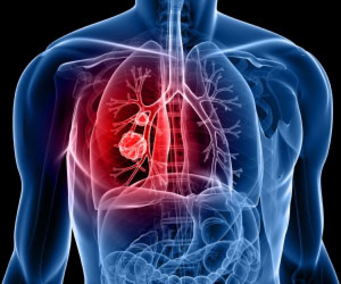 Хроническая обструктивная болезнь лёгких (ХОБЛ / ХОЗЛ)