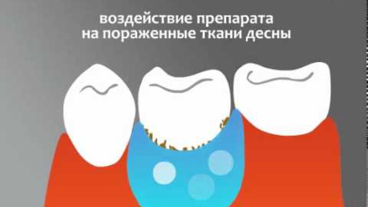 Зубы - Лечение пародонтита