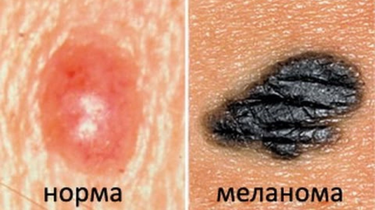 Как распространяются метастазы при раке (на примере меланомы)?