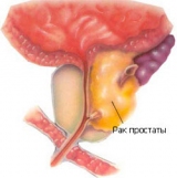 Рак простаты