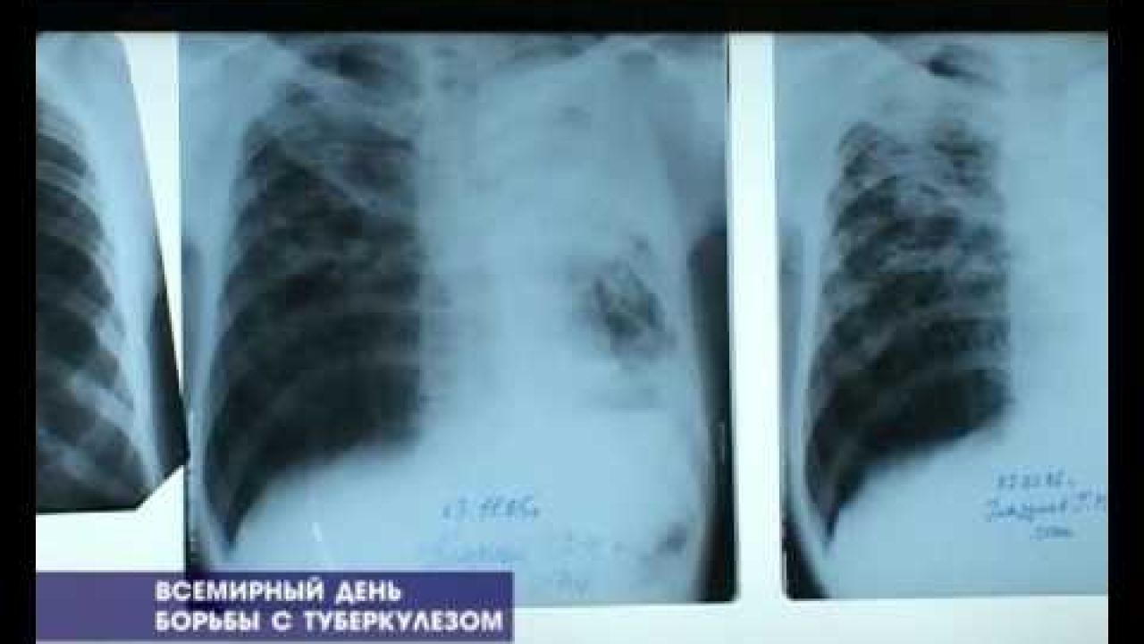 Туберкулёз -  причины и симптомы