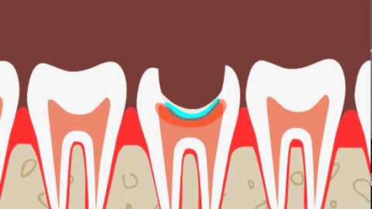 Зубы - Лечение пульпита